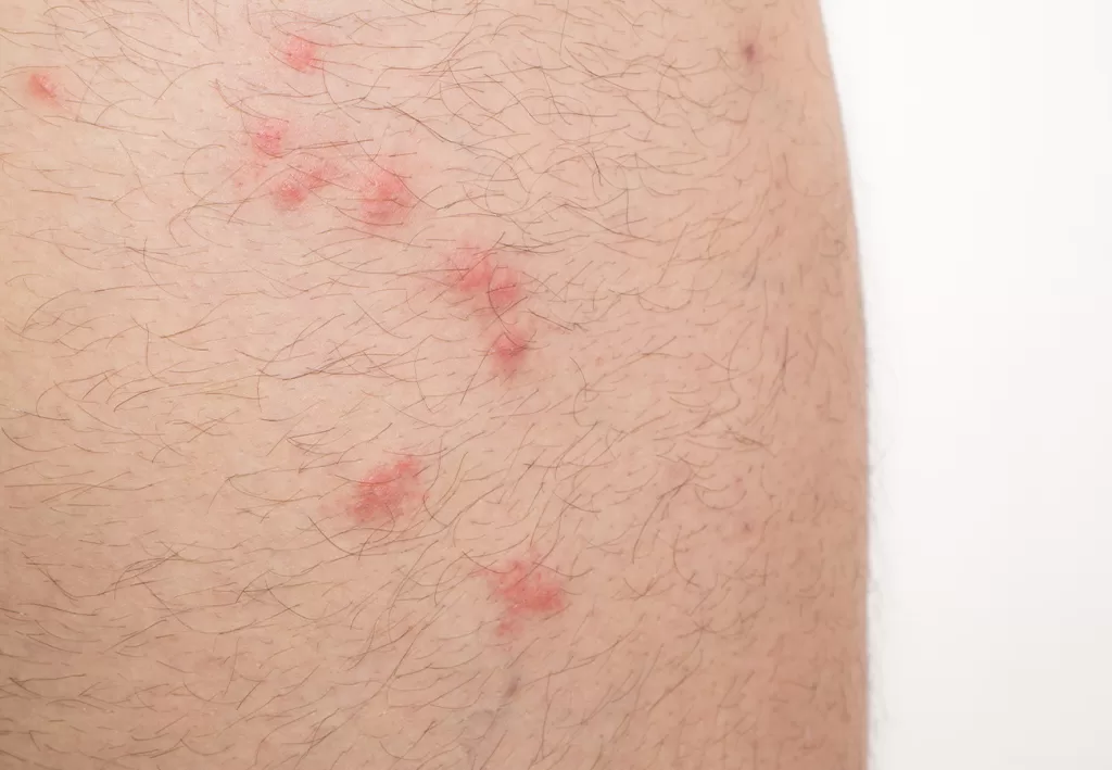 البراغيث هل البراغيث خطرة على البشر؟ 1