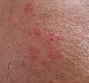 Flea Bites